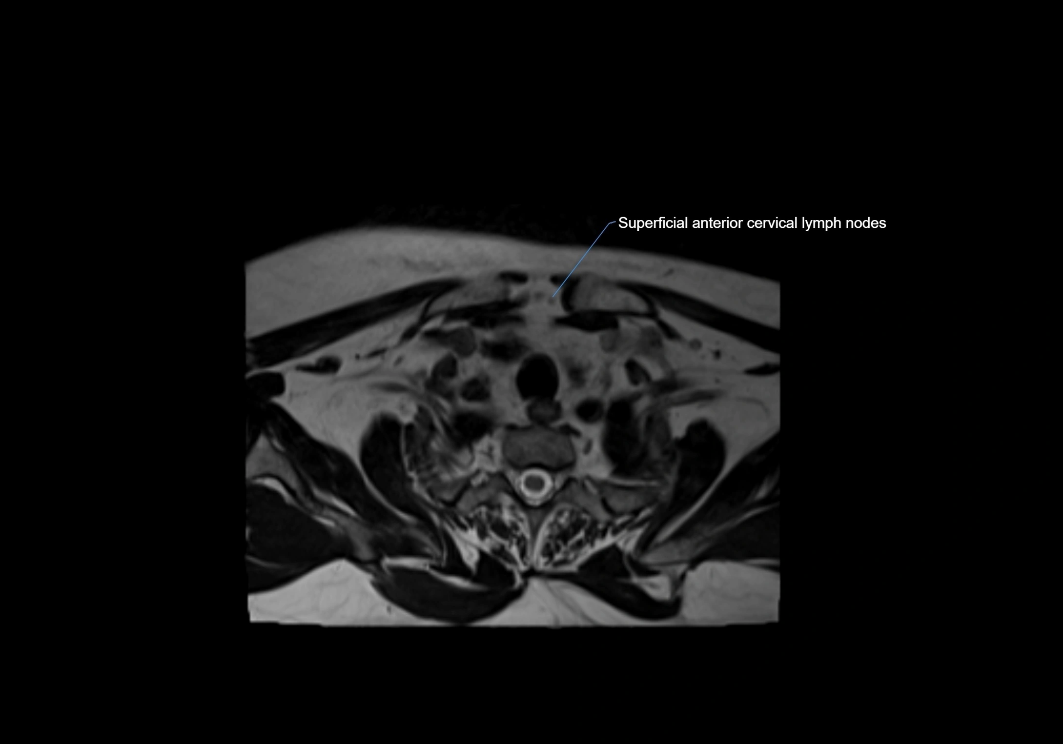 Neck axial  lymph node cross sectional MRI anatomy 3T MRI  image-img-00001-00093.webp